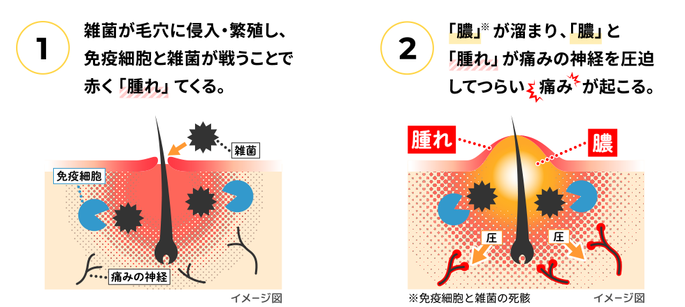 ①雑菌が毛穴に侵入・繁殖し、免疫細胞と雑菌が戦うことで赤く「腫れ」てくる。→②「膿」が溜まり、「膿」と「腫れ」が痛みの神経を圧迫してつらい痛みが起きる。