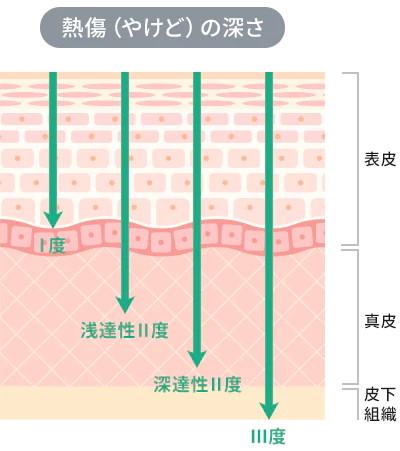 やけどの深さのイメージ