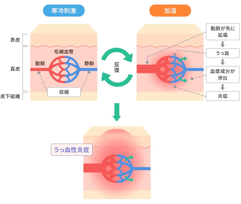 しもやけが発症する仕組みのイメージ図