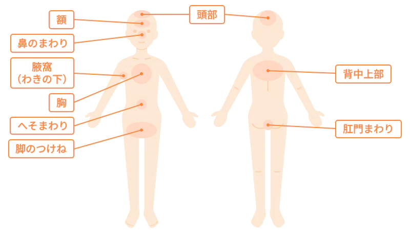 症状が出やすい部分のイメージ図