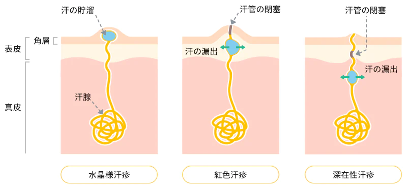 あせもの種類のイメージ図