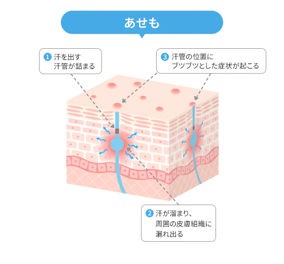 あせものイメージ