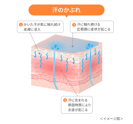 汗かぶれのイメージ